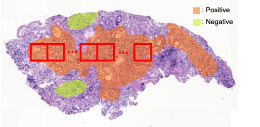 소화기조직 병리검사 이미지-활용 모델 _1_학습 패치 추출 예시