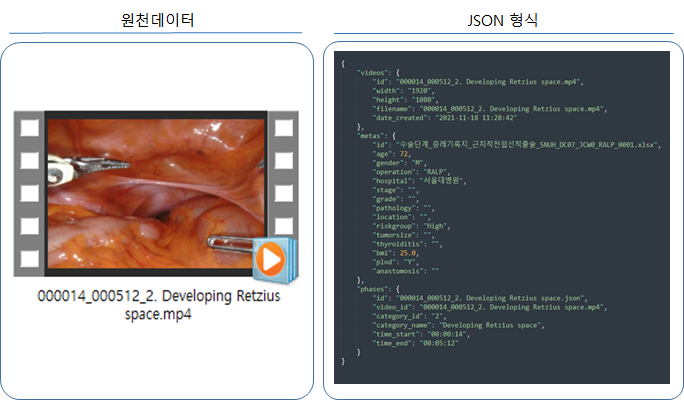 6개암 최소침습수술 AI학습데이터-데이터 포맷-수술단계 동영상