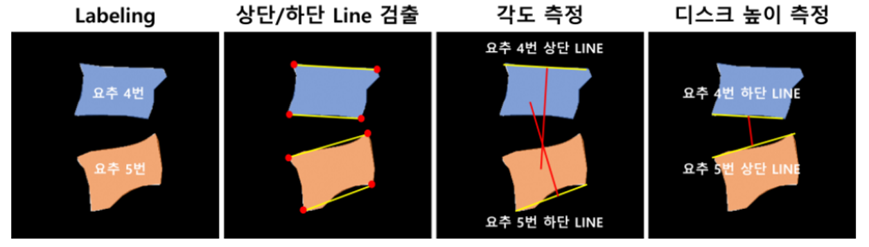 퇴행성 척추질환 진단 및 치료를 위한 멀티모달리티 데이터-요추 분할 모델 및 디스크 높이 측정 알고리즘-Predict 결과물의 각도와 거리 측정-요추 4, 5번 간의 디스크 높이 및 각도 측정