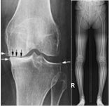 통증치료 및 경과관찰을 위한 멀티모달리티 데이터-데이터 종류 예시_1_X-ray 예시