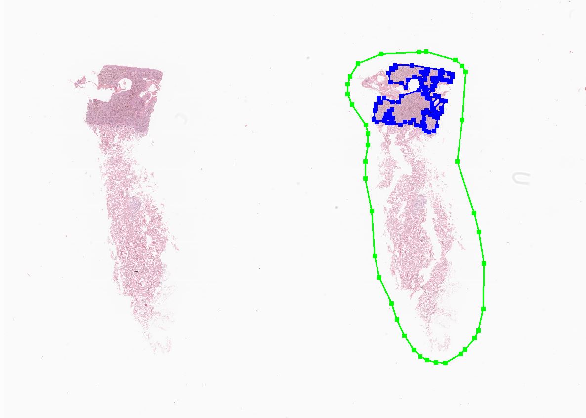 - 지루각화증 (Seborrheic keratosis)