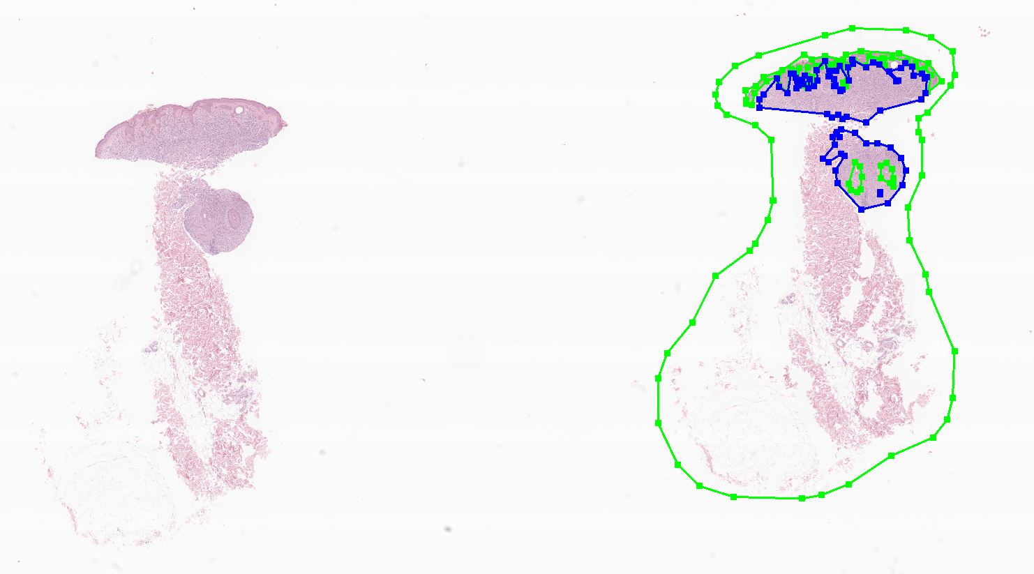 - 멜라닌세포모반 (Melanocytic nevus)