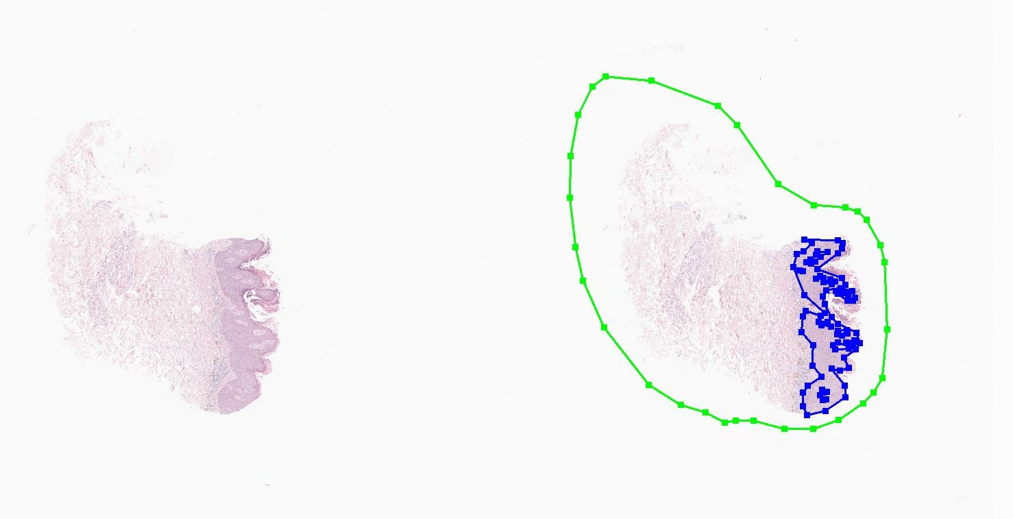 - 보웬병/편평상피암 (Bowen disease/Squamous cell carcinoma)