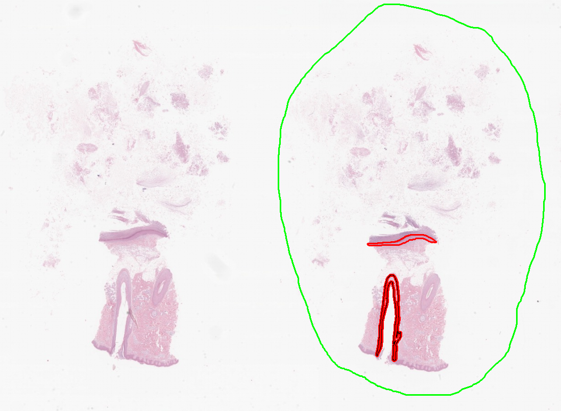 ) 세부데이터별 원천데이터와 데이터 가공 예시 - 표피낭종 (Epidermal cyst)