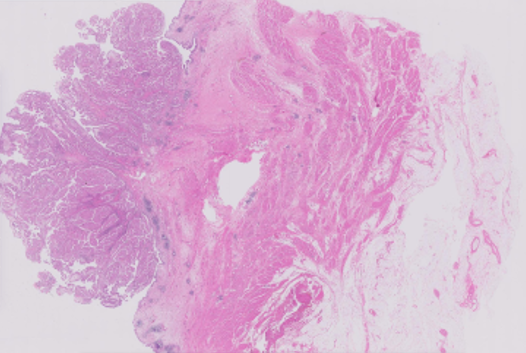 방광암WSI_원천데이터 이미지